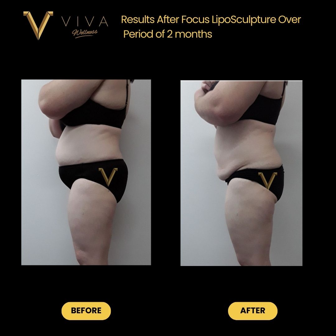 Images of abdomen showing fat reduction following liposculpture treatments over two months