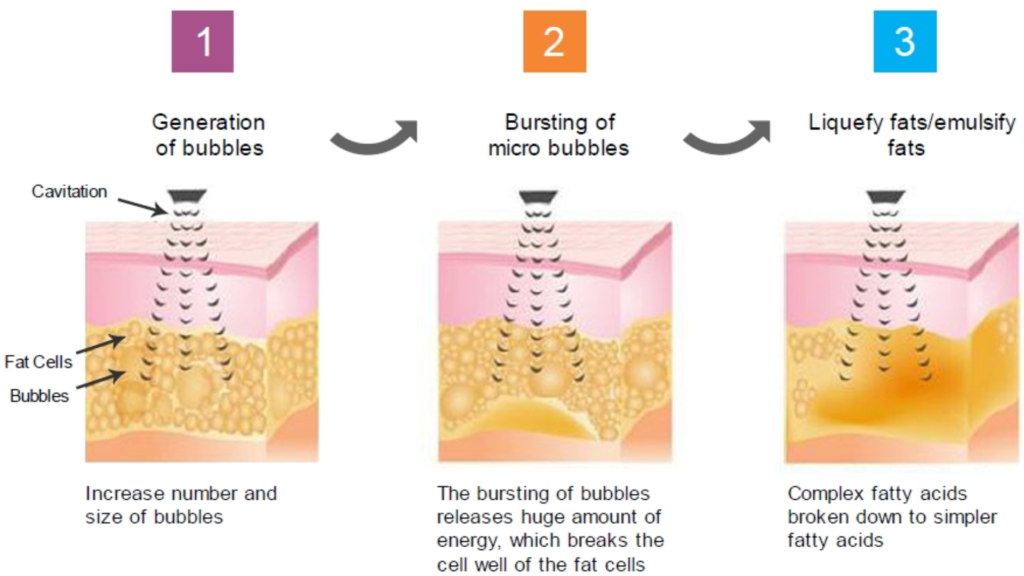 HOW DOES lpg endermologie WORK What Is Fat Cavitation, and How Does It Work?