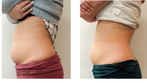 Before and After Fat Cavitation belly side 2