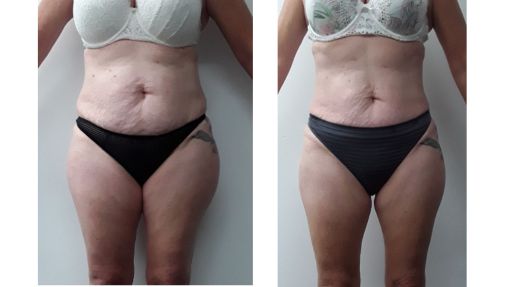 Ultrasound fat cavitation results abdomen front