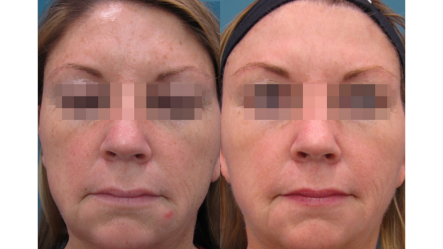 Chemical peels for wrinkles, best skin resurfacing treatments, anti-aging exfoliation.