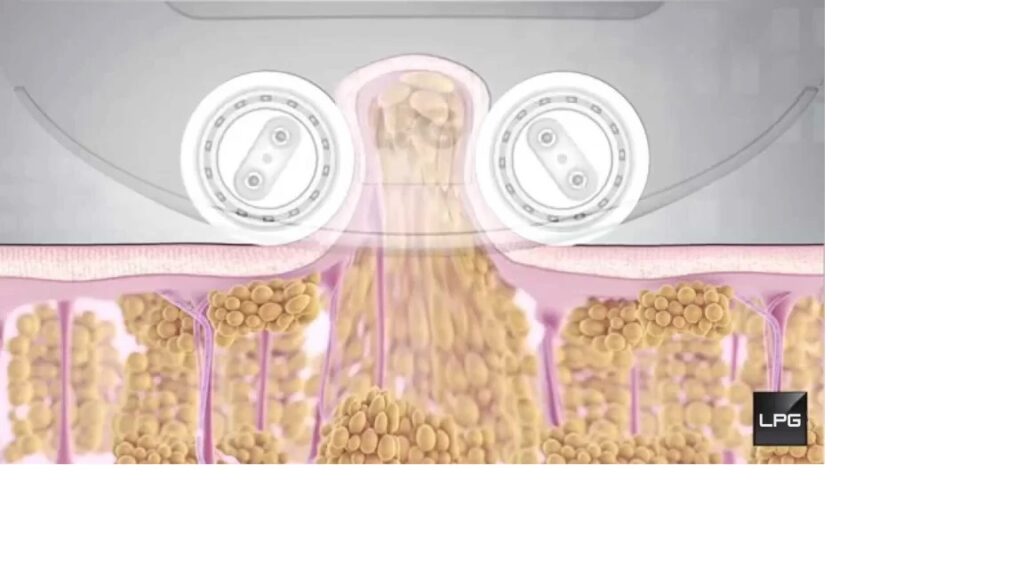 LPG-Endermologie Benefits Post Lipo Surgery How LPG Endermologie works to reduce cellulite
