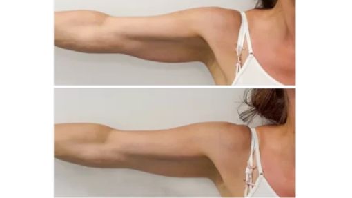 HOW DOES lpg endermologie WORK How long do results last for Skin Tightening Treatments