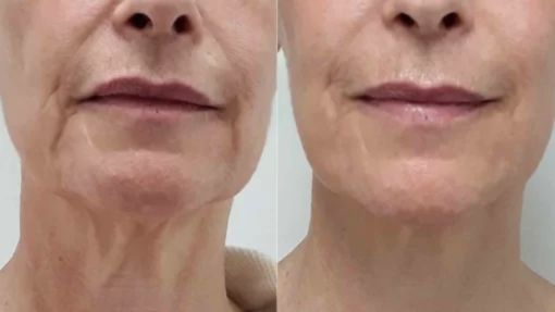 HOW DOES lpg endermologie WORK Top Benefits of Skin Tightening Treatments