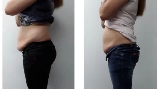 HOW DOES lpg endermologie WORK Skin tightening treatments can also target various areas of the body