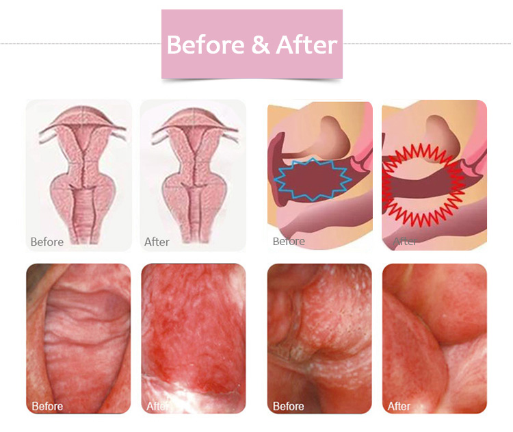 vaginal HIFU Before & After